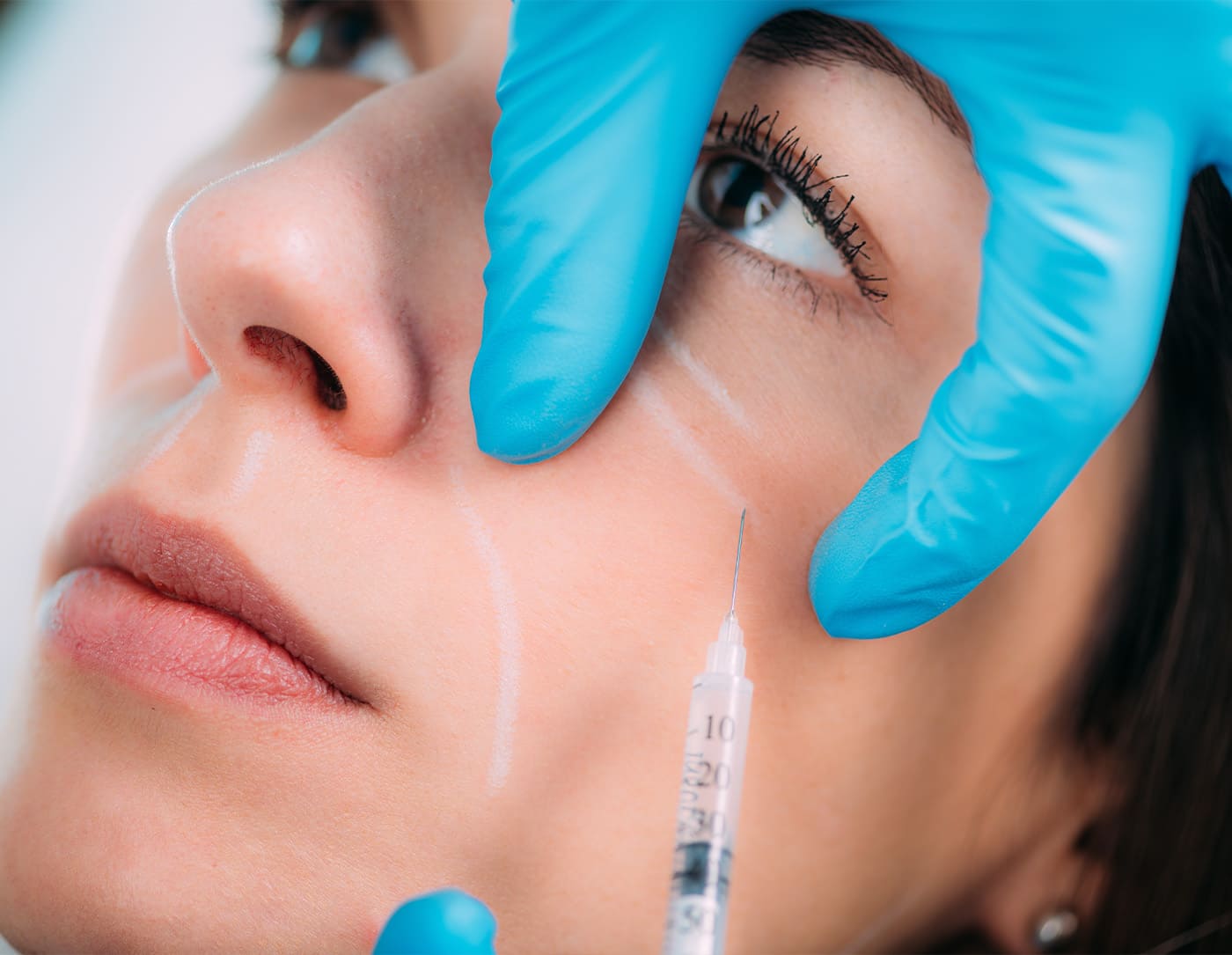 Hyaluron-Behandlung bei HP Aesthetics – Sanfte Faltenreduktion & Volumenaufbau