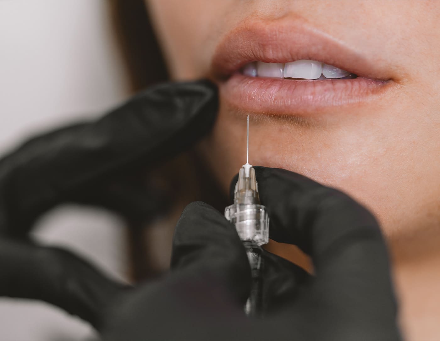 Hylase-Behandlung bei HP Aesthetics – Korrektur und Auflösung von Hyaluron-Fillern